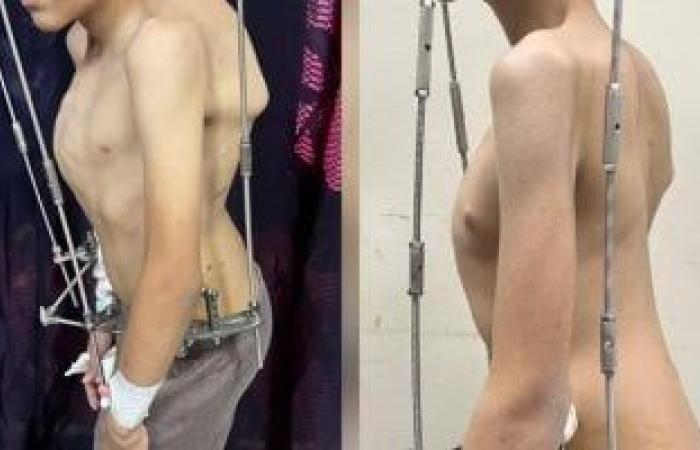 فريق طبى بمستشفى الزهراء الجامعى يجرى جراحة لتصحيح تشوه بالعمود الفقرى - بوابة نيوز مصر