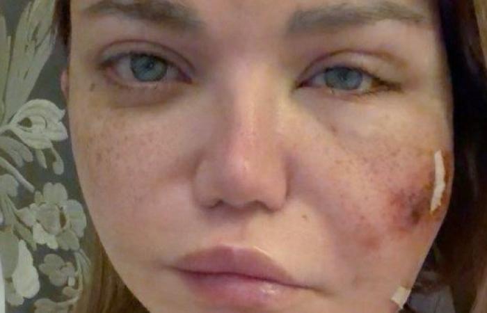 جراحة دقيقة .. ياسمين الخطيب تعلن إصابتها بعدوى بكتيرية في أنسجة بشرة الوجه - بوابة نيوز مصر