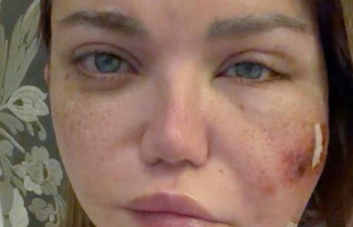 مرض ياسمين الخطيب.. أسباب وأعراض خراجات الوجه - بوابة نيوز مصر