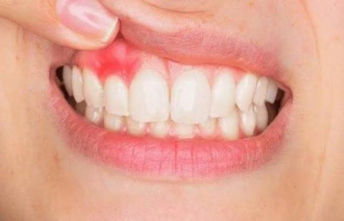 علاج التهاب اللثة.. إليك أفضل الطرق - بوابة نيوز مصر
