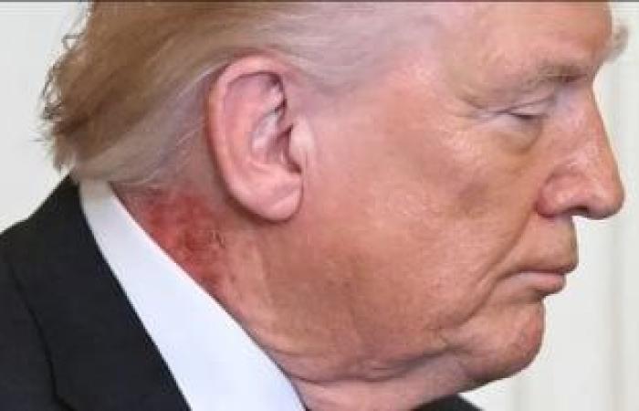 "بقعة حمراء" في رقبة دونالد ترامب تثير التكهنات.. صورة - بوابة نيوز مصر