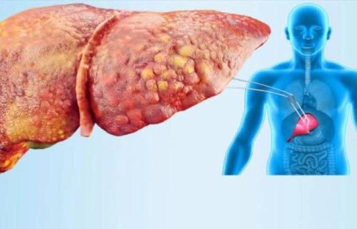احذر .. علامة هامة تشير لإصابتك بمرض الكبد الدهني - بوابة نيوز مصر