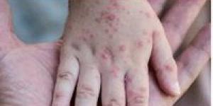 India Reports Its First Case of Virulent Mpox Virus Strain - بوابة نيوز مصر