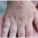 India Reports Its First Case of Virulent Mpox Virus Strain - بوابة نيوز مصر